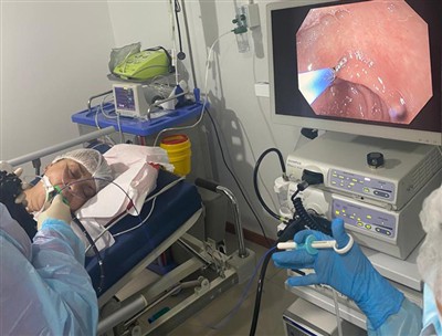 Einnota vefjasýnistöng klínískt tilfelli (frá umboðsmanni í Chile)